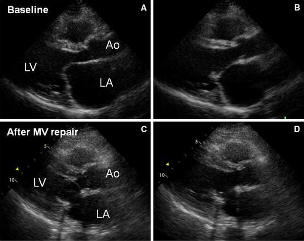 Reconsiderations of mitral stenosis: rheumatic mitral valve repair and ...