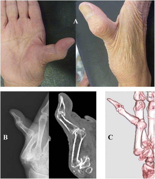 Correction of a Hyperextension Deformity at the Metacarpophalangeal