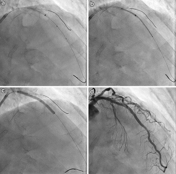 stent with guideliner stent with guideliner