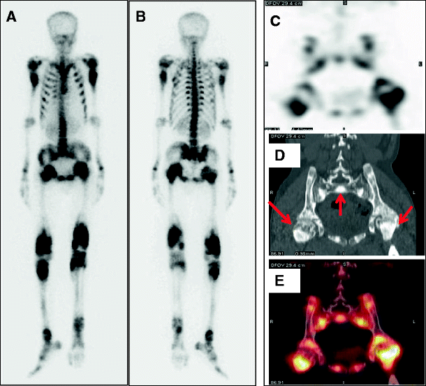 Bone Scan and SPECT/CT Findings in Marble Bone Disease SpringerLink