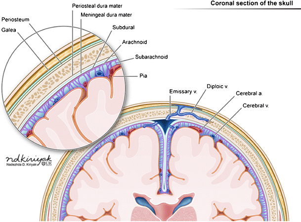 mechanical birth related trauma to the neonate an imaging subgaleal hemorrhage