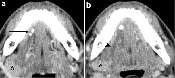 Imaging Of The Sublingual And Submandibular Spaces