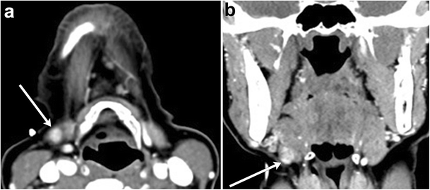 Imaging Of The Sublingual And Submandibular Spaces