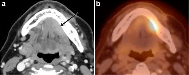 Imaging Of The Sublingual And Submandibular Spaces