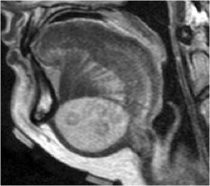 Imaging Of The Sublingual And Submandibular Spaces