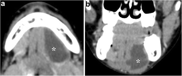 Imaging Of The Sublingual And Submandibular Spaces