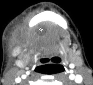 Imaging Of The Sublingual And Submandibular Spaces