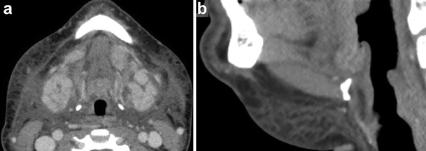 Imaging Of The Sublingual And Submandibular Spaces