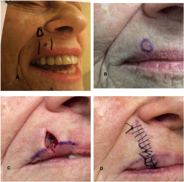 Basal Cell Carcinoma A Patient and Physician’s Experience SpringerLink