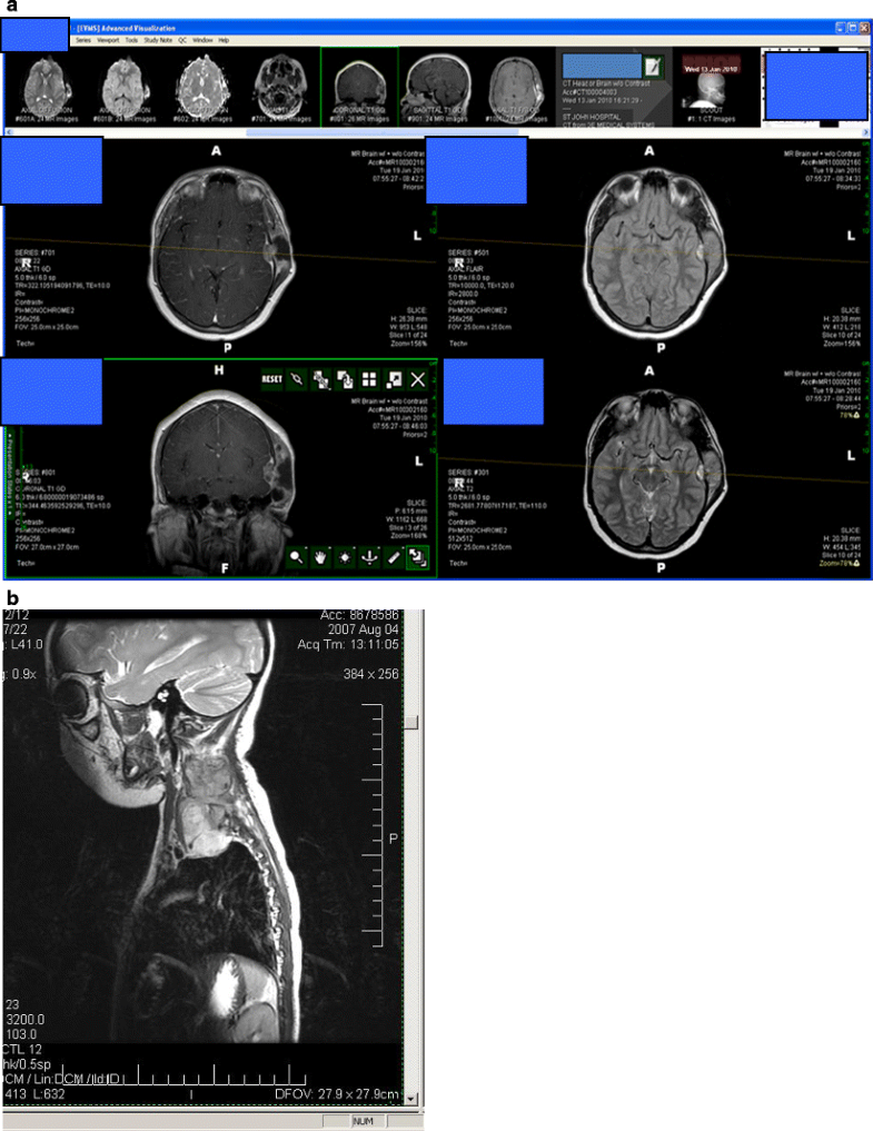 Ewing's sarcoma prognosis image