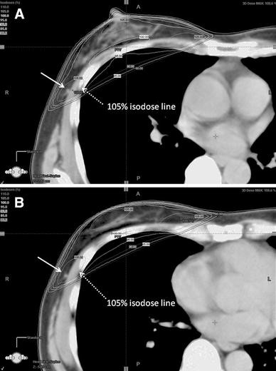 A case of Mondor's disease after whole breast radiotherapy ...
