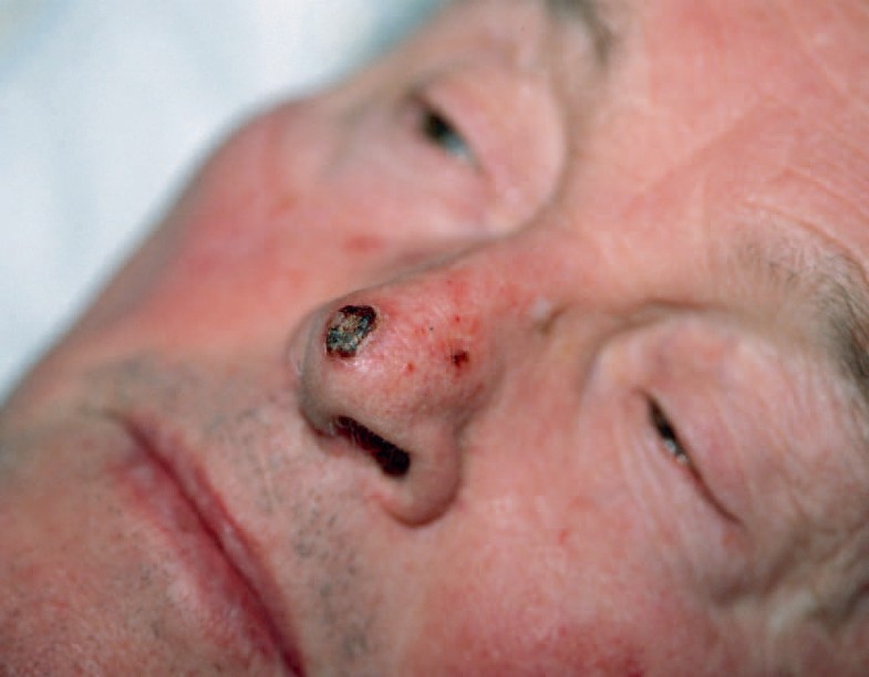 Basaliom unvollständig entfernt? Sofort nachschneiden! SpringerLink Basaliom unvollständig entfernt? Sofort nachschneiden! SpringerLink