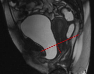 Magnetic Resonance Imaging Of Female Pelvic Floor