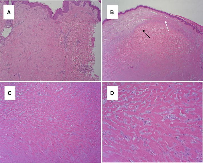 Keloids and Hypertrophic Scars A Spectrum of Clinical Challenges SpringerLink