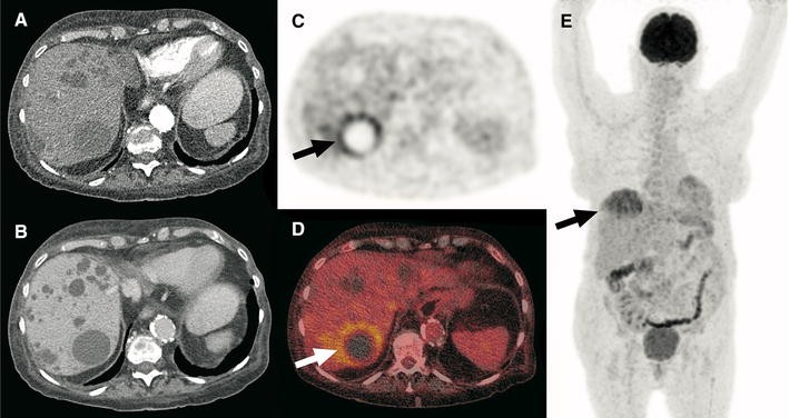 FDG-PET/CT for diagnosis of cyst infection in autosomal dominant ...