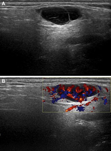 Ultrasound in sialadenitis | SpringerLink