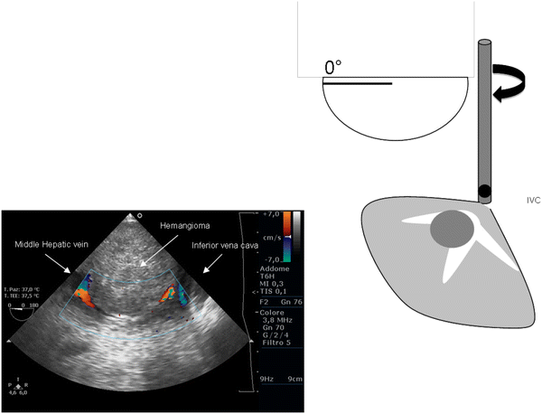 Could Transesophageal Echocardiography Be Useful In Selected