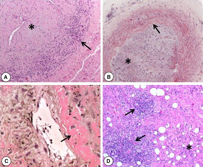 Kidney involvement in medium and largevessel vasculitis SpringerLink