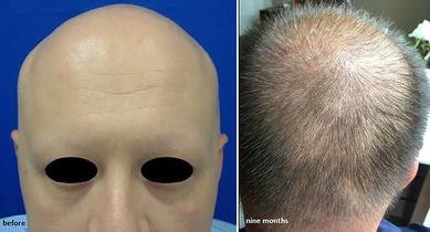 alopecia universalis treatment 2017