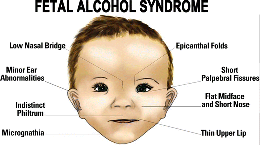 A Short Note On Fetal Alcohol Spectrum