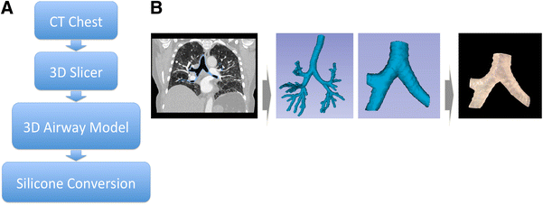 3D Printing and Personalized Airway Stents  SpringerLink