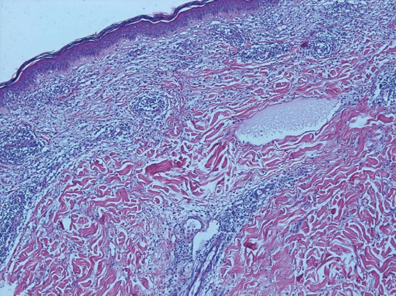 DelayedType Heparin Allergy Diagnostic Procedures and Treatment