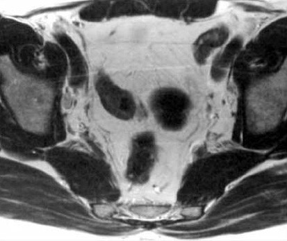 CT/MRI of nodal metastases in pelvic cancer | Cancer Imaging | Full Text