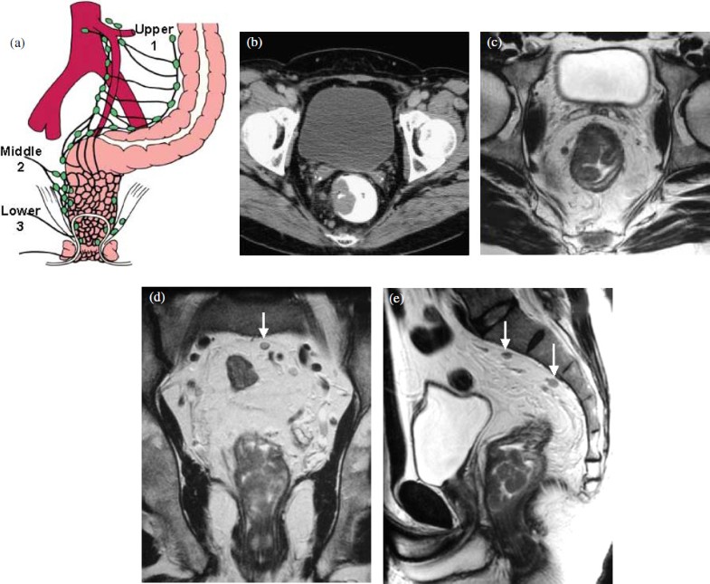 CT/MRI of nodal metastases in pelvic cancer | Cancer Imaging | Full Text