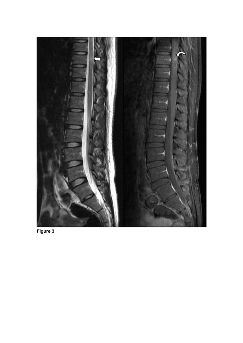 Multiple sclerosis presenting initially with a worsening of migraine