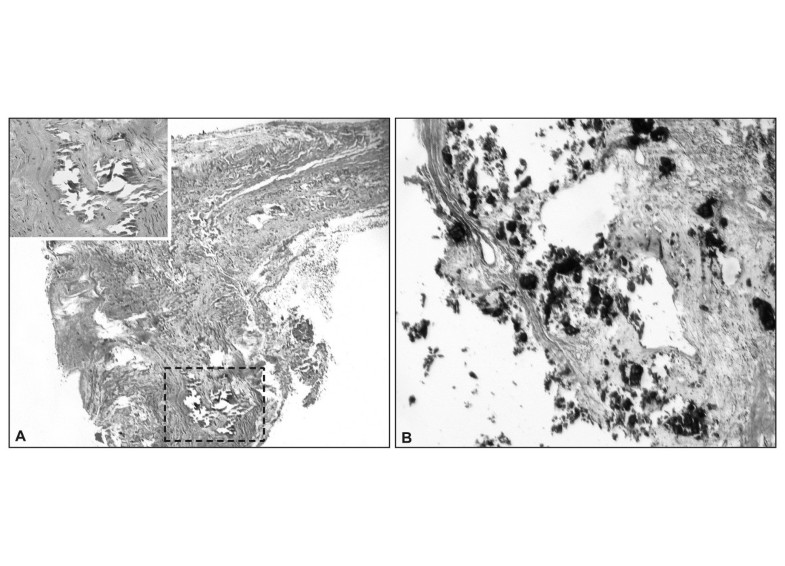 Mönckeberg's sclerosis is the artery the only target of calcification