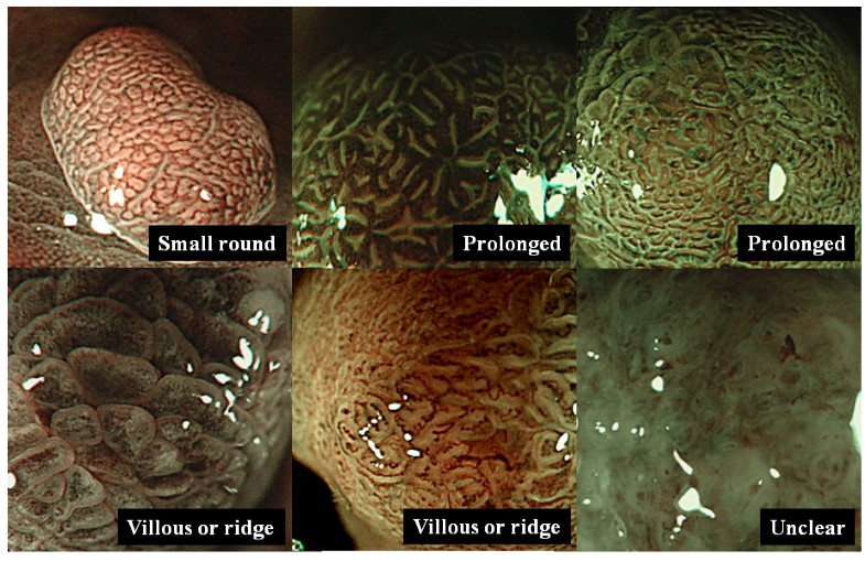 Correlation between magnifying narrow band imaging and histopathology