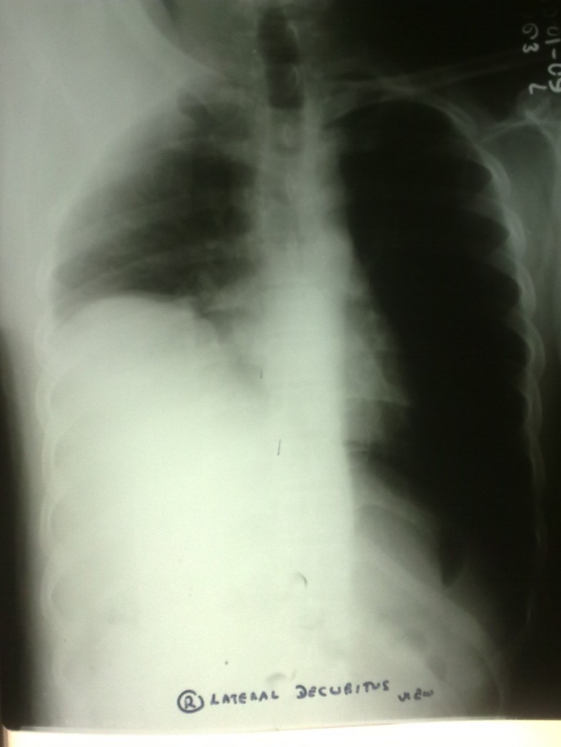 Diaphragmatic paralysis a rare consequence of dengue fever BMC Infectious Diseases Full Text