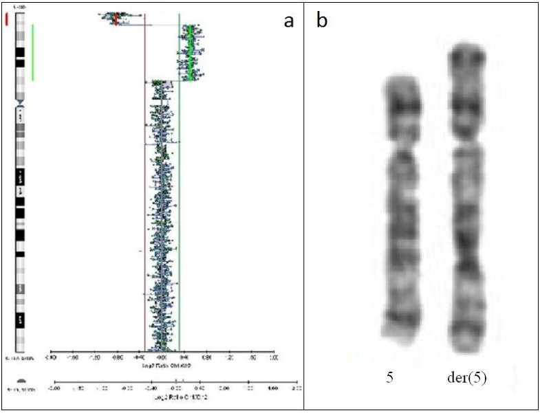 A coalescence of two syndromes in a girl with terminal deletion and