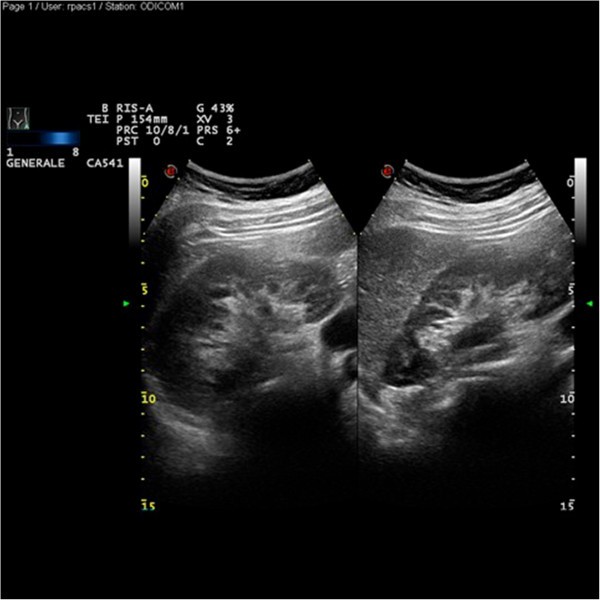 Excessive urinary tract dilatation and proteinuria in pregnancy a