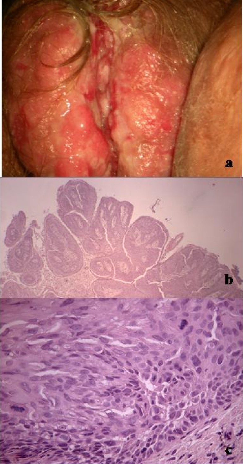 pictures of vulvar cancer