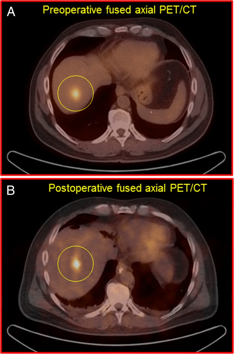 18FFDG PET/CT oncologic imaging at extended injectiontoscan