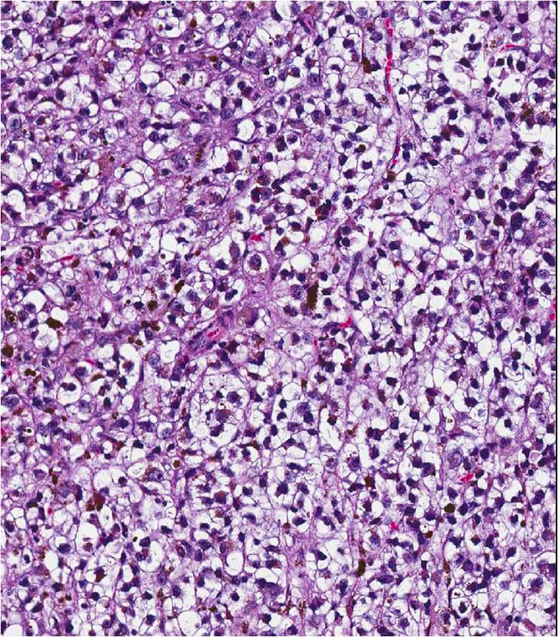GNAQmutation in a patient with metastatic mucosal melanoma BMC Cancer