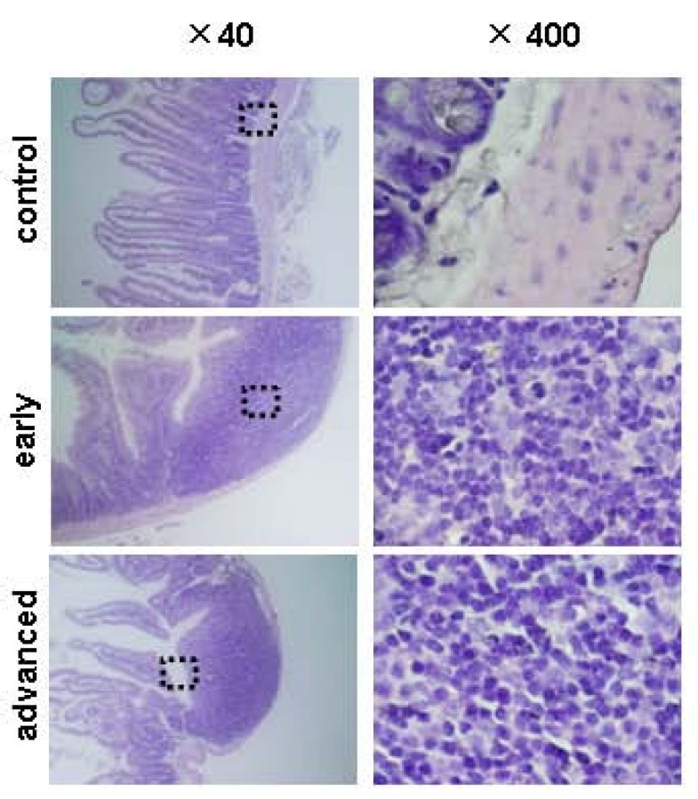 Spontaneous transformation of human granulosa cell tumours 
