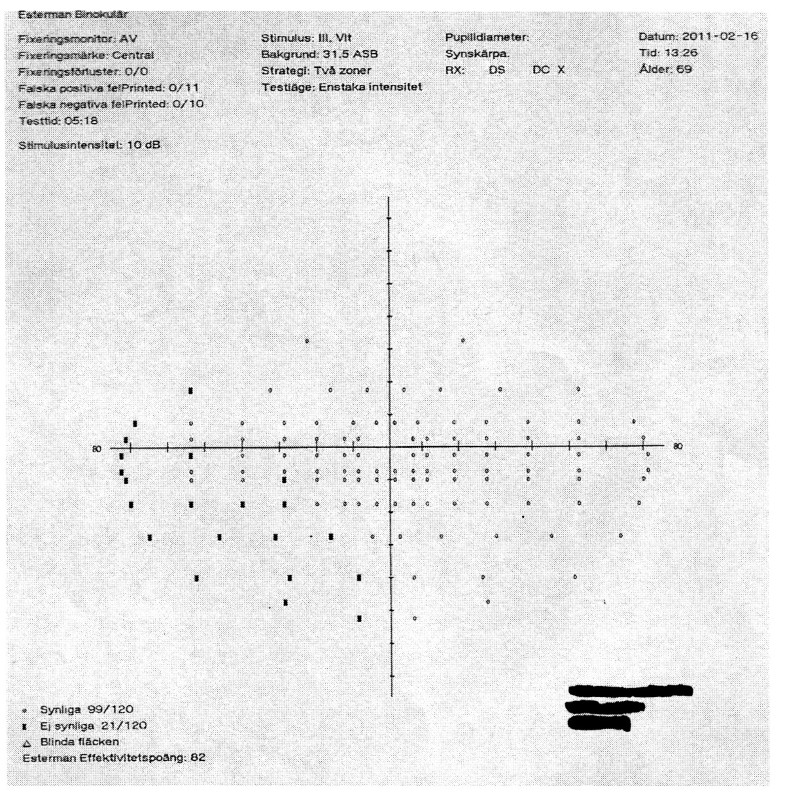 Comparison of the monocular Humphrey visual field and the binocular