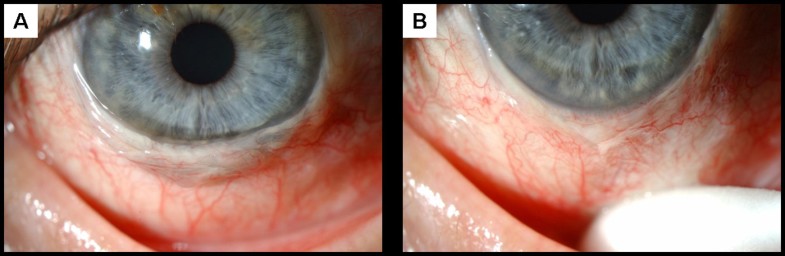Severe conjunctivochalasis in association with classic type Ehlers