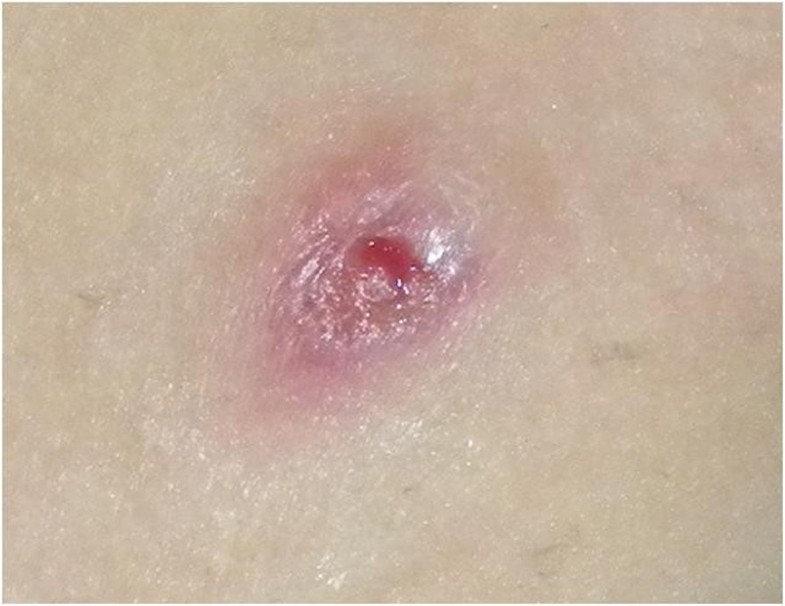 Chronic granulomatous disease mimicking earlyonset Crohn’s disease with cutaneous