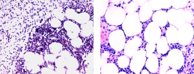 A patient with Pfeifer-Weber-Christian Disease - Successful Therapy