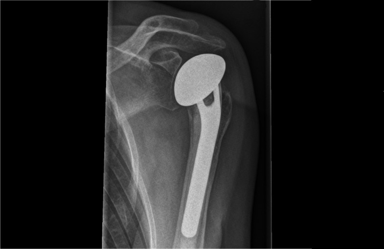 Stable osteosynthesis 05 image