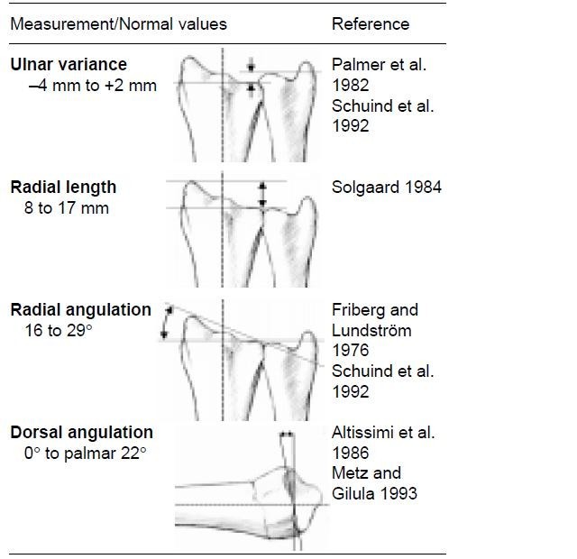 of 92 factors are in a distal prognostic Early in factors radius fractures