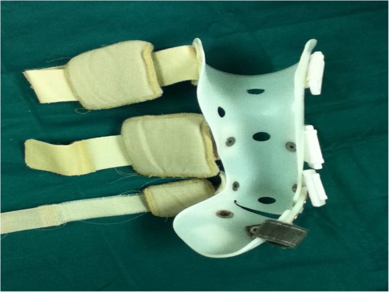 Manipulation and brace fixing for the treatment of congenital clubfoot