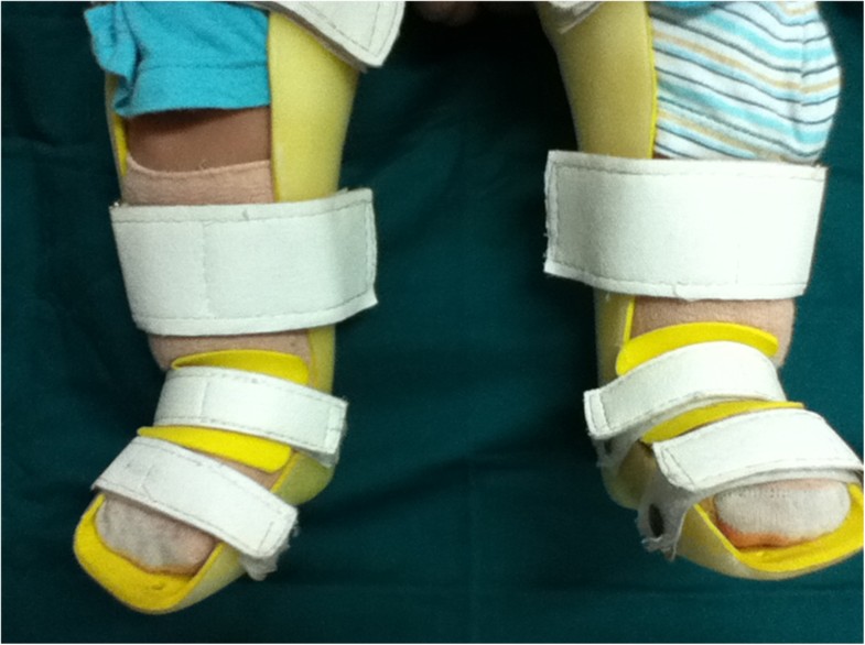 Manipulation and brace fixing for the treatment of congenital clubfoot