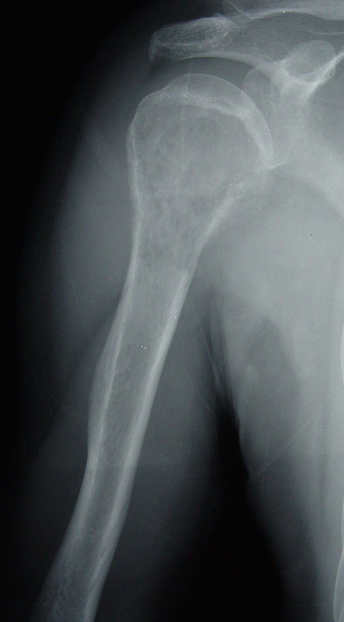 Treatment and of malignant bone tumors of the proximal humerus
