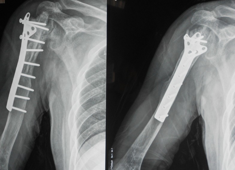 Treatment and of malignant bone tumors of the proximal humerus