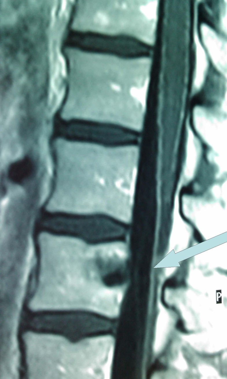 Swordfish bill injury involving abdomen and vertebral column case