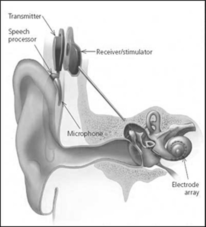Cochlear implantation in the elderly surgical and hearing